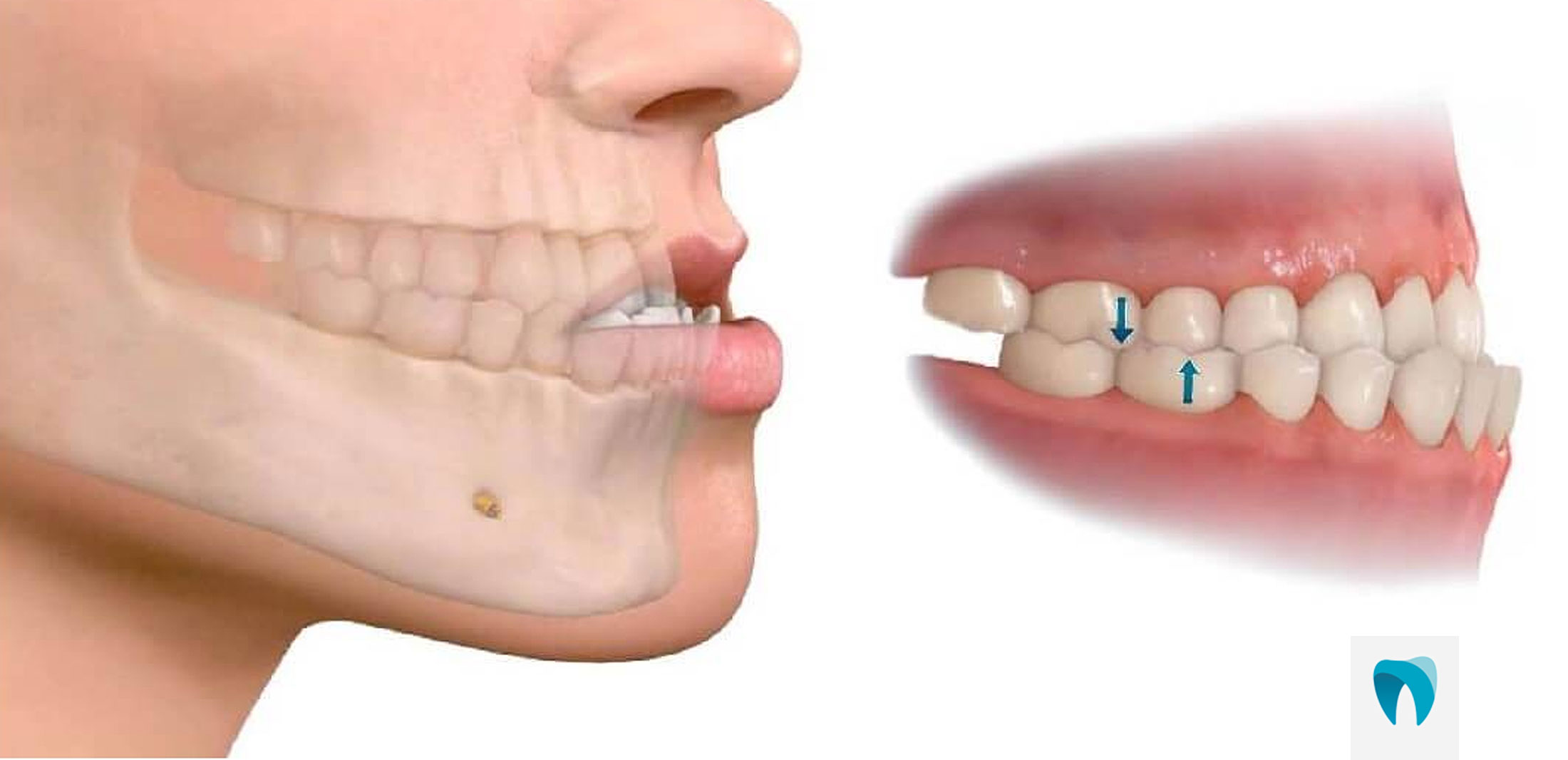 https://www.ortofacil.com.br/wp-content/uploads/2021/06/OFbucomaxilo.jpg